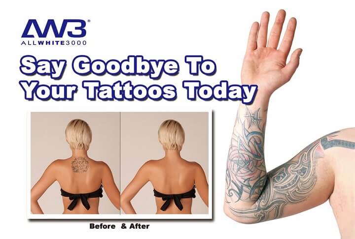 tattoo removal