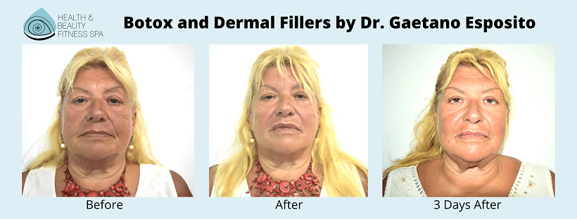 botox and derma filler before and after